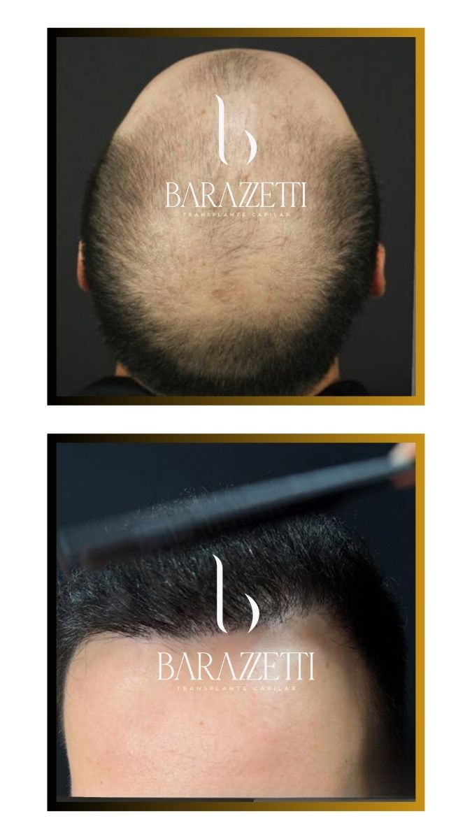 Antes e depois (6)
